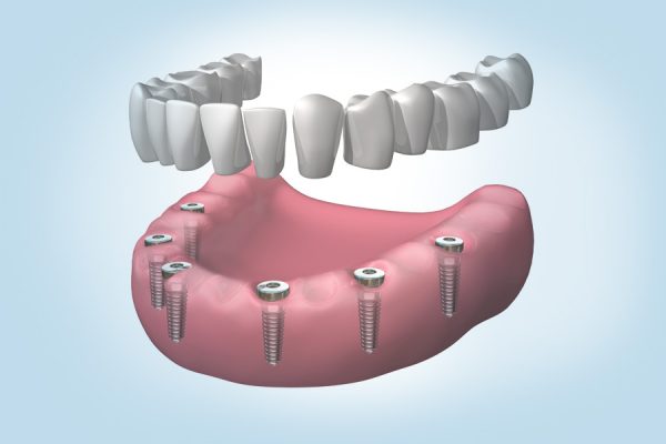Diferentes opciones sobre implantes dentales en Palau-solità i Plegamans