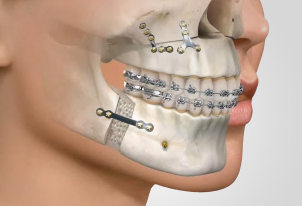ortodoncia en Palau-solità i Plegamans